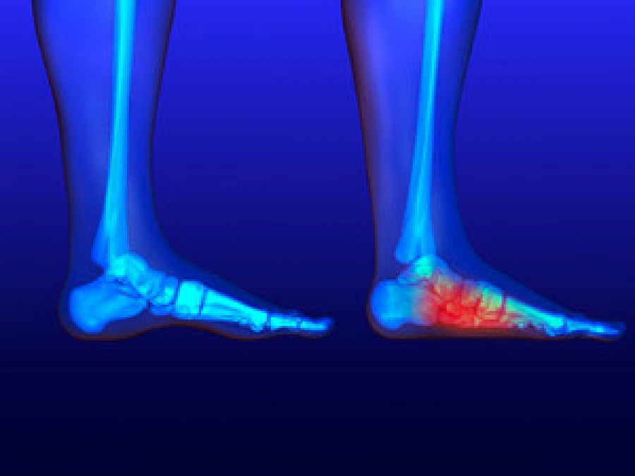 What Is The Difference Between Flat Feet And High Arches
